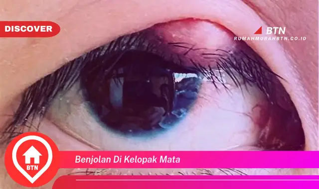 benjolan di kelopak mata