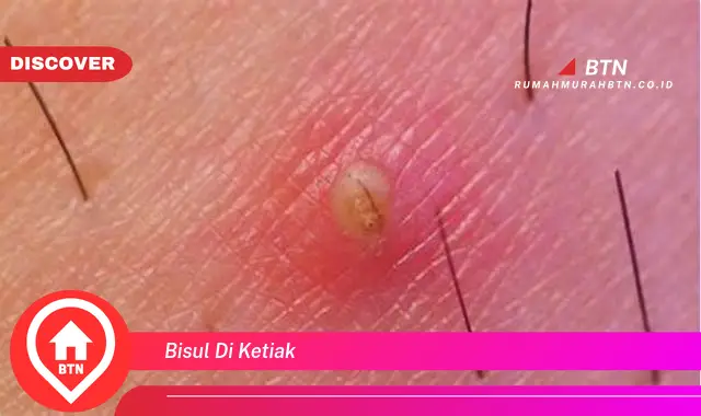 bisul di ketiak