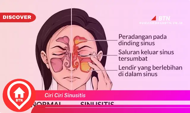 ciri ciri sinusitis