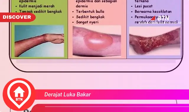 derajat luka bakar