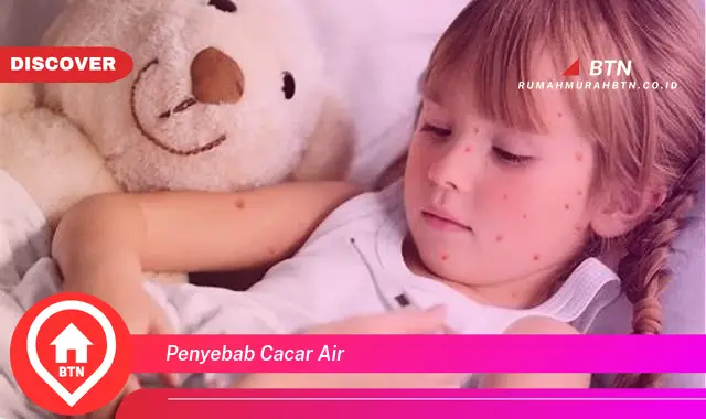 penyebab cacar air