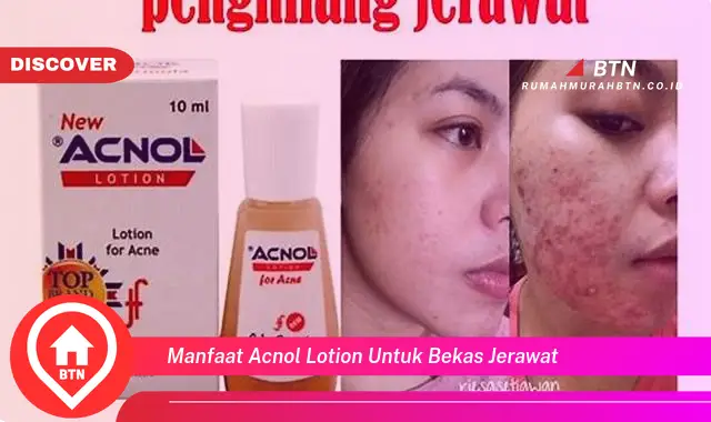 manfaat acnol lotion untuk bekas jerawat